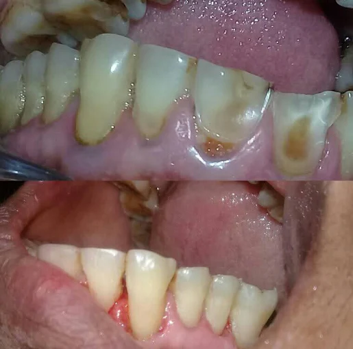 Scaling & Polishing